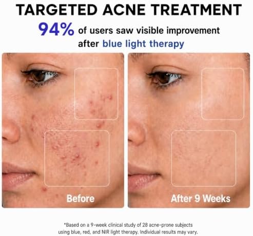 FDA-Cleared Blue Light Therapy for Acne with Mild-to-Moderate Inflammation - Image 2
