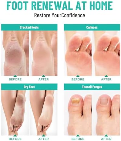 Foot Soak with Epsom Salt 12 Pack Pedicure Spa for Dry Feet - Image 4