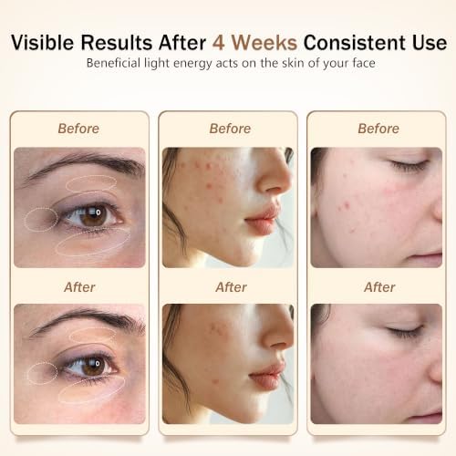 Red Light Therapy Mask for Face, 850nmNIR Treats Acne & Wrinkles - Image 3