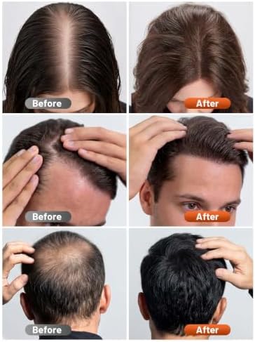 RELEXNOW Red Light Therapy Cap for Hair with Upgraded 180 Tri-Chip LEDs - Image 2