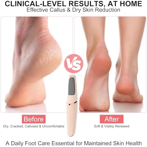 2026 Pro Electric Foot File,Callus Remover for Feet - Image 2