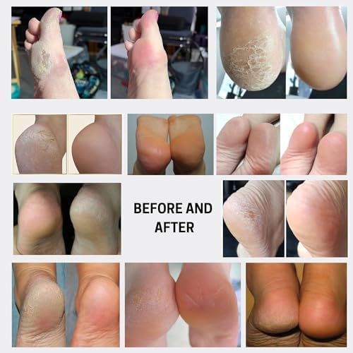 Feet Callus Remover Softener Spray, Gentle Fast-Acting Formula - Image 3